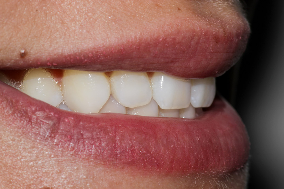 Side view close up of a person's lips and teeth after diastema closure