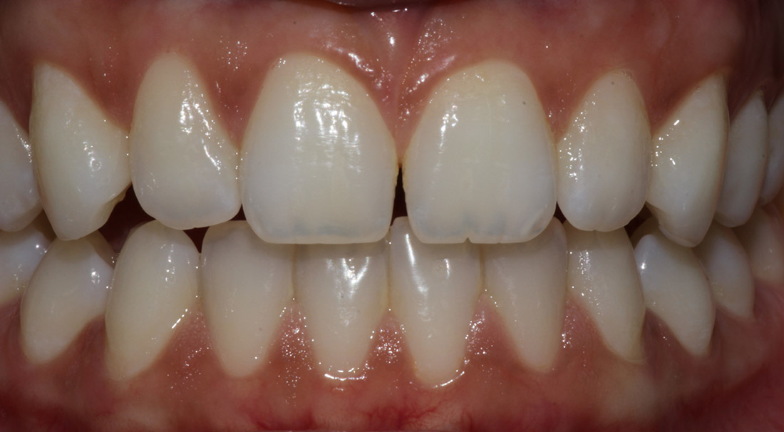 Front view close up of a a person's teeth and gums before diastema closure
