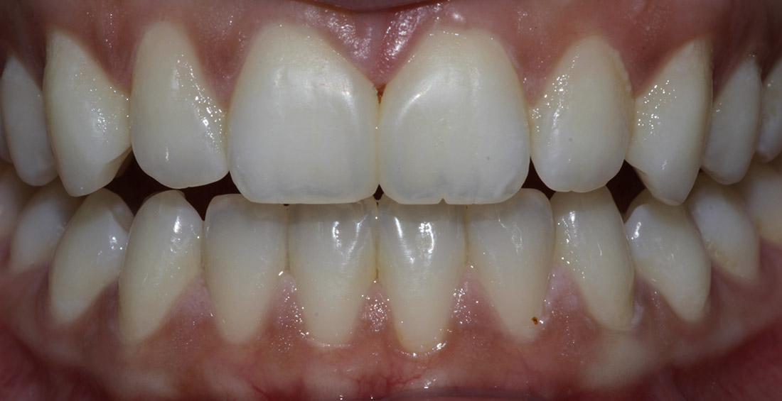 Front view close up of a a person's teeth and gums after diastema closure