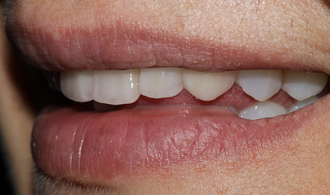 Side view close up of a person's lips and teeth after getting porcelain crowns made by Vermont Dental Ceramics