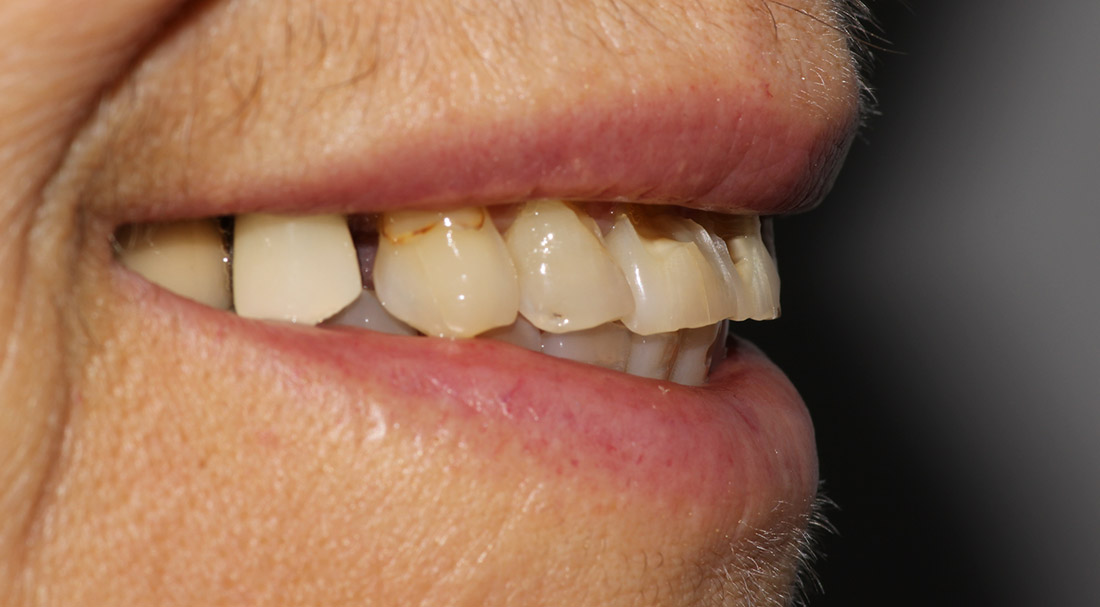 Side view close up of a person's mouth and cracked teeth before getting crowns
